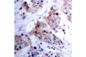 Immunohistochemical analysis of ARHGAP23 staining in human breast cancer formalin fixed paraffin embedded tissue section. (ARHGAP23 抗体)