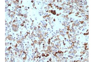 Formalin-fixed, paraffin-embedded human Melanoma stained with MITF Mouse Monoclonal Antibody (MITF/915). (MITF 抗体)