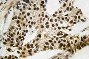 Immunohistochemistry (IHC) analyzes of MAPKAPK-2 antibody in paraffin-embedded human breast carcinoma tissue. (MAPKAP Kinase 2 抗体)