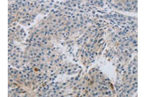 The image on the left is immunohistochemistry of paraffin-embedded Human liver cancer tissue using ABIN7191430(MCMBP Antibody) at dilution 1/60, on the right is treated with synthetic peptide. (MCMBP 抗体)