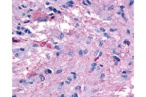 Anti-GPR139 antibody IHC of human Brain, Glioblastoma. (GPR139 抗体  (Transmembrane Domain))