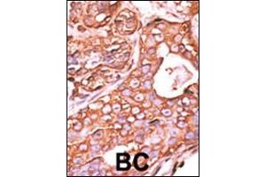 Formalin-fixed and paraffin-embedded human cancer tissue reacted with the primary antibody, which was peroxidase-conjugated to the secondary antibody, followed by AEC staining. (PPM1F 抗体  (N-Term))