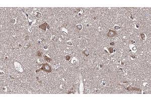ABIN6277608 at 1/100 staining Human brain cancer tissue by IHC-P. (PSRC1 抗体  (Internal Region))