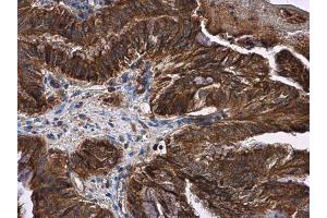 IHC-P Image LOXL2 antibody detects LOXL2 protein at cytoplasm and membrane in human cervical carcinoma by immunohistochemical analysis. (LOXL2 抗体)