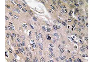 Immunohistochemical analysis of paraffin-embedded human lung cancer tissue using BMP6 polyclonal antibody . (BMP6 抗体)