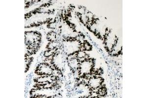 Immunohistochemical analysis of BAF53A staining in human colon cancer formalin fixed paraffin embedded tissue section.