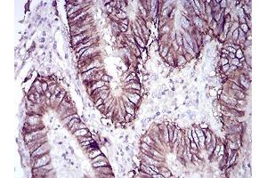 Immunohistochemical analysis of paraffin-embedded rectum cancer tissues using CDH17 mouse mAb with DAB staining.