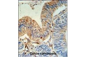 HLA-DRA Antibody (N-term) (ABIN390770 and ABIN2841028) IHC analysis in formalin fixed and paraffin embedded human colon carcinoma followed by peroxidase conjugation of the secondary antibody and DAB staining.