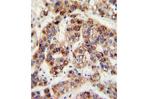 Formalin-fixed and paraffin-embedded human hepatoarcinoma with OTC Antibody (Center), which was peroxidase-conjugated to the secondary antibody, followed by DAB staining. (OTC 抗体  (AA 71-98))