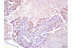 Formalin-fixed and paraffin embedded human lung carcinoma labeled with Anti-FOXM1 Polyclonal Antibody, Unconjugated (ABIN749138) at 1:200 followed by conjugation to the secondary antibody and DAB staining