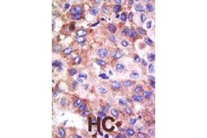 Formalin-fixed and paraffin-embedded human cancer tissue reacted with the primary antibody, which was peroxidase-conjugated to the secondary antibody, followed by DAB staining. (UBE2G1 抗体  (N-Term))