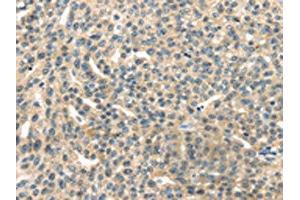 The image on the left is immunohistochemistry of paraffin-embedded Human esophagus cancer tissue using ABIN7192147(RASA2 Antibody) at dilution 1/45, on the right is treated with synthetic peptide. (RASA2 抗体)