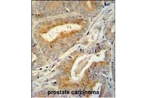 BCORL1 antibody (N-term) (ABIN654801 and ABIN2844476) immunohistochemistry analysis in formalin fixed and paraffin embedded human prostate carcinoma followed by peroxidase conjugation of the secondary antibody and DAB staining.