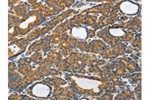 The image on the left is immunohistochemistry of paraffin-embedded Human thyroid cancer tissue using ABIN7130809(RAMP3 Antibody) at dilution 1/40, on the right is treated with fusion protein. (RAMP3 抗体)