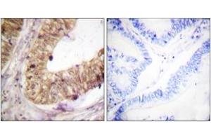 Immunohistochemistry analysis of paraffin-embedded human colon carcinoma tissue, using ATRIP (Ab-68/72) Antibody. (ATRIP 抗体  (AA 34-83))