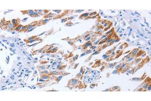 Immunohistochemistry of paraffin-embedded Human lung cancer using KIF3A Polyclonal Antibody at dilution of 1:40 (KIF3A 抗体)