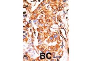 Formalin-fixed and paraffin-embedded human cancer tissue reacted with the primary antibody, which was peroxidase-conjugated to the secondary antibody, followed by AEC staining. (GK2 抗体  (C-Term))