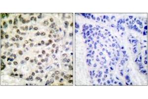 Immunohistochemistry analysis of paraffin-embedded human breast carcinoma tissue, using POLR2A (Ab-1619) Antibody. (POLR2A/RPB1 抗体  (AA 1585-1634))