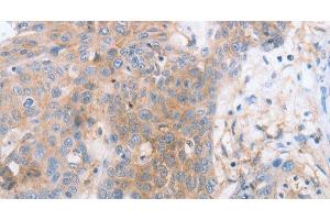 Immunohistochemistry of paraffin-embedded Human esophagus cancer tissue using CD85d Polyclonal Antibody at dilution 1:30