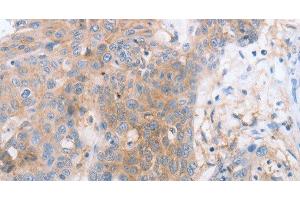 Immunohistochemistry of paraffin-embedded Human esophagus cancer tissue using CD85d Polyclonal Antibody at dilution 1:30 (LILRB2 抗体)
