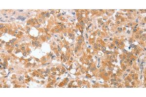 Immunohistochemistry of paraffin-embedded Human thyroid cancer tissue using cPLA2 Polyclonal Antibody at dilution 1:40 (PLA2G4A 抗体)