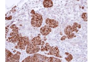 IHC-P Image Immunohistochemical analysis of paraffin-embedded SW480 Xenograft, using S100A11, antibody at 1:500 dilution. (S100A11 抗体)