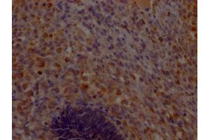 IHC image of ABIN7148184 diluted at 1:200 and staining in paraffin-embedded human ovarian cancer performed on a Leica BondTM system. (CHCHD5 抗体  (AA 1-110))