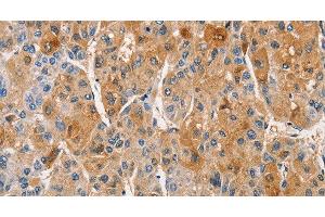 Immunohistochemistry of paraffin-embedded Human liver cancer using PKC epsilon Polyclonal Antibody at dilution of 1:50 (PKC epsilon 抗体)