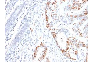 Immunohistochemistry (IHC) image for anti-Tumor Protein P53 (TP53) antibody (ABIN6940777)