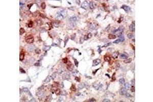 IHC analysis of FFPE human breast carcinoma tissue stained with the AKT3 antibody (AKT3 抗体  (AA 88-118))