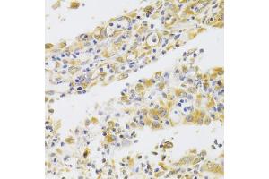 Immunohistochemistry of paraffin-embedded human gastric cancer using PA2G4 Antibody (ABIN5973112) at dilution of 1/100 (40x lens). (PA2G4 抗体)