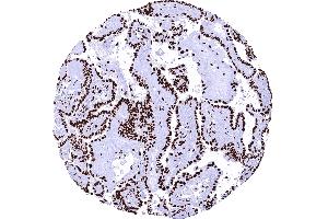 Papillary thyroid cancer with strong nuclear TRIM28 immunostaining of tumor cells (Recombinant KAP1 抗体  (Center))