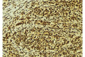 ABIN6274176 at 1/100 staining Human breast cancer tissue by IHC-P. (TCF3 抗体  (Internal Region))