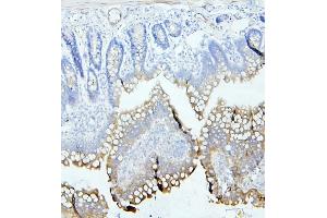 IHC analysis of CEACAM5 using anti-CEACAM5 antibody (ABIN7601435).