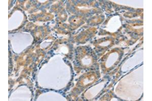 The image on the left is immunohistochemistry of paraffin-embedded Human thyroid cancer tissue using ABIN7192586(SNX29 Antibody) at dilution 1/20, on the right is treated with synthetic peptide. (SNX29 抗体)