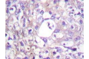 Immunohistochemistry analyzes of SH-PTP2 antibody in paraffin-embedded human breast carcinoma tissue. (PTPN11 抗体)