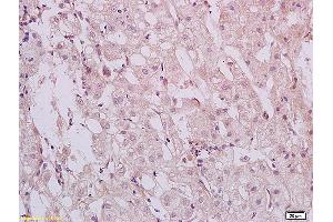 Formalin-fixed and paraffin embedded human hepatitides tissue labeled with Anti HBXIP Polyclonal Antibody,Unconjugated (ABIN873319) at 1:200 followed by conjugation to the secondary antibody and DAB staining. (HBXIP 抗体  (AA 41-91))