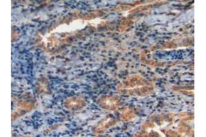 IHC-P analysis of Human Thyroid Cancer Tissue, with DAB staining. (GLA 抗体  (AA 1-80))