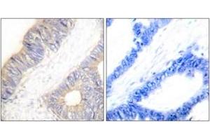 Immunohistochemistry analysis of paraffin-embedded human colon carcinoma tissue, using Stefin A Antibody. (CSTA 抗体  (AA 49-98))