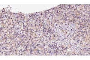 ABIN6273095 at 1/100 staining Human lymph cancer tissue by IHC-P. (CCDC22 抗体  (C-Term))