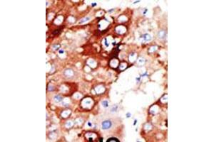 Formalin-fixed and paraffin-embedded human cancer tissue reacted with the primary antibody, which was peroxidase-conjugated to the secondary antibody, followed by DAB staining. (ACSL4 抗体  (AA 236-267))