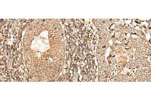 Immunohistochemistry of paraffin-embedded Human esophagus cancer tissue using GALR2 Polyclonal Antibody at dilution of 1:40(x200) (GALR2 抗体)