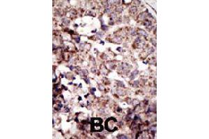 Formalin-fixed and paraffin-embedded human cancer tissue reacted with AGER polyclonal antibody  , which was peroxidase-conjugated to the secondary antibody, followed by AEC staining . (RAGE 抗体  (N-Term))