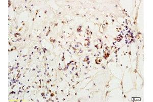 Formalin-fixed and paraffin embedded human breast carcinoma labeled with Anti-MCP-2 Polyclonal Antibody, Unconjugated  at 1:200 followed by conjugation to the secondary antibody and DAB staining