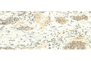 Immunohistochemistry of paraffin-embedded Human esophagus cancer tissue using ATMIN Polyclonal Antibody at dilution of 1:50(x200) (ATM Interactor 抗体)