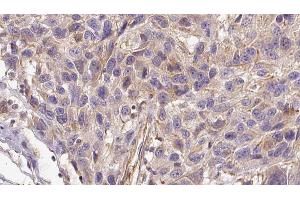 ABIN6272953 at 1/100 staining Human Melanoma tissue by IHC-P. (AGGF1 抗体  (Internal Region))