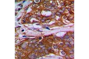 Immunohistochemical analysis of MRPL22 staining in human prostate cancer formalin fixed paraffin embedded tissue section. (MRPL22 抗体)