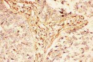 Anti-LIF Picoband antibody,  IHC(P): Human Lung Cancer Tissue (LIF 抗体  (AA 23-202))
