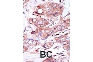 Formalin-fixed and paraffin-embedded human cancer tissue reacted with the primary antibody, which was peroxidase-conjugated to the secondary antibody, followed by DAB staining.