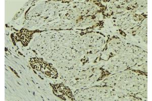 ABIN6273133 at 1/100 staining Human breast cancer tissue by IHC-P. (MGH1/2 抗体)